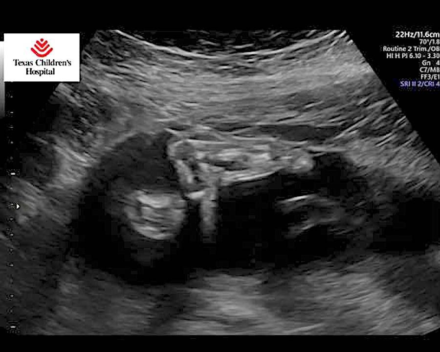 An ultrasound image of Parker Kate Avera’s feet after her parents saw them moving. (Facebook).jpg